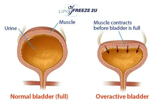 diagram of overactive bladder treatment Colchester
