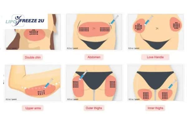 Benefits of Choosing Aqualyx for Fat Reduction Colchester