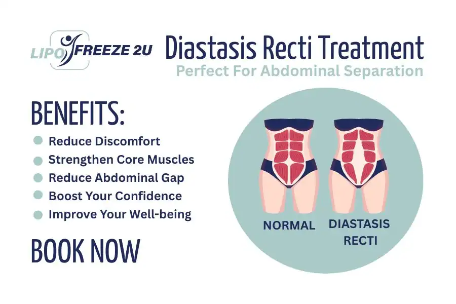 How Long Will It Take to See Improvements in Diastasis Recti Colchester