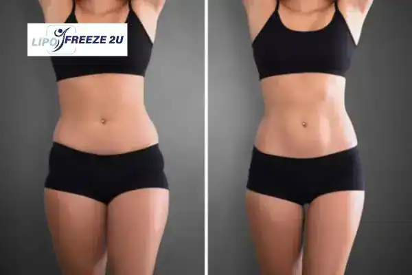 How Can LIPO FREEZE 2U Support Your Post-Pregnancy Body Recovery Colchester?