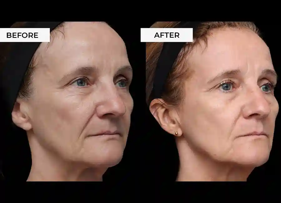 How Many RF Microneedling Sessions Will You Need to See a Difference Colchester?