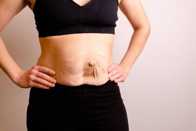 Is Surgery Really the Only Way to Repair Diastasis Recti Colchester?