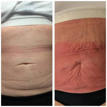 How Does RF Microneedling Improve Crepey, Thin and Uneven Skin Texture Colchester?