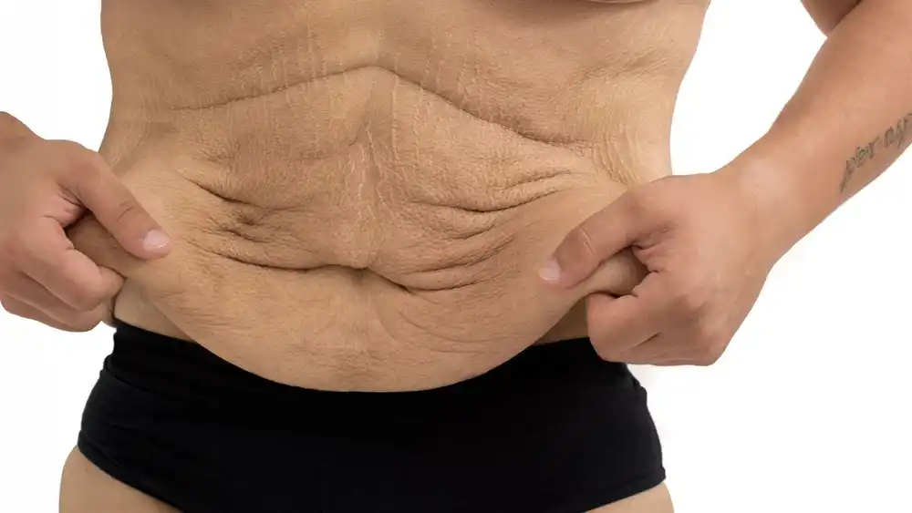 RF Microneedling for Loose Skin: How Can It Help Tighten and Reshape the Skin Colchester?